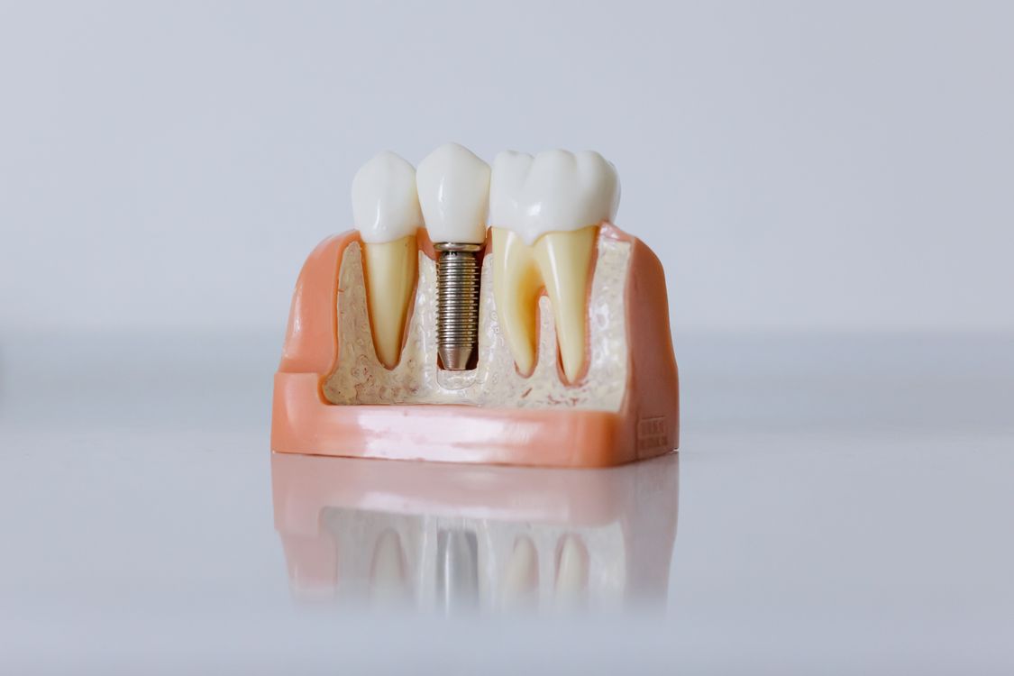 Modelo odontológico mostrando um implante e sua coroa entre dentes naturais